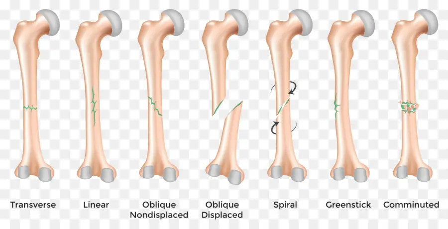 Fractures Osseuses，Casser PNG