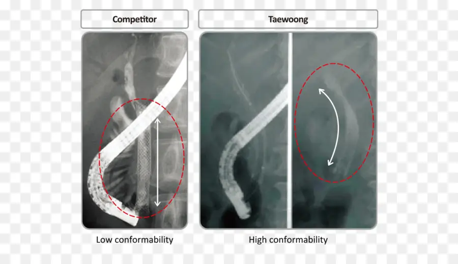 Stenting，Tractus Biliaire PNG