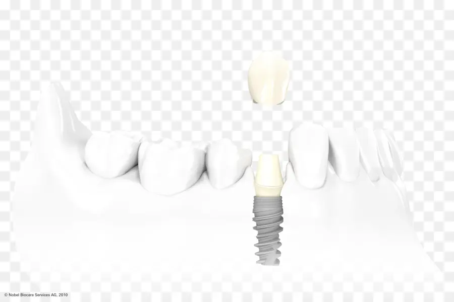 Implant Dentaire，La Dentisterie PNG