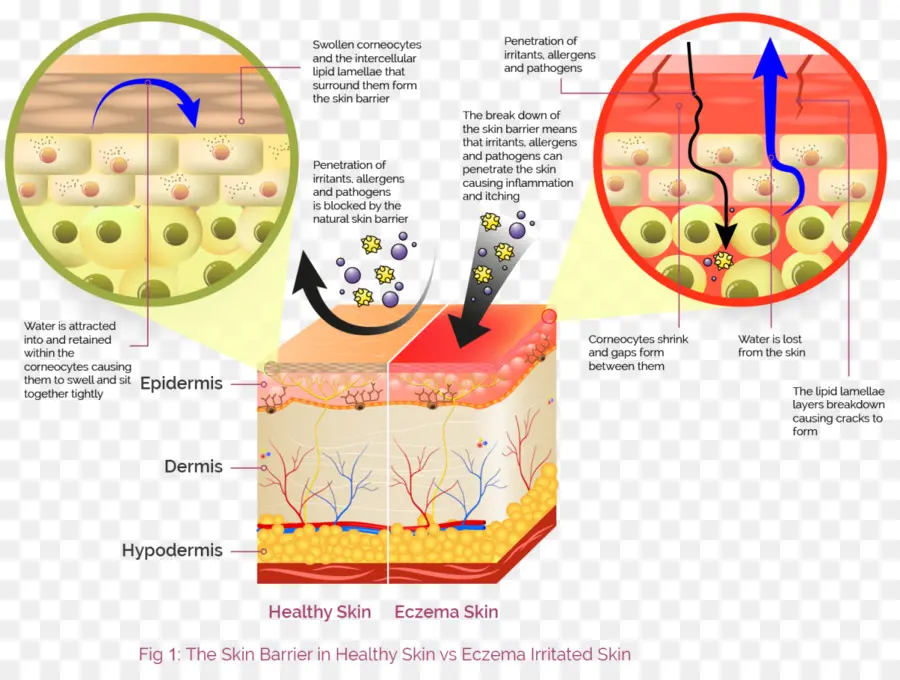 Diagramme De Peau，Eczéma PNG