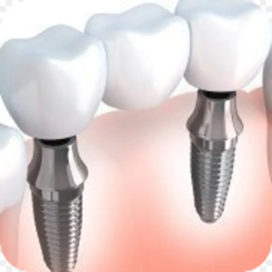 Implants Dentaires，Dents PNG