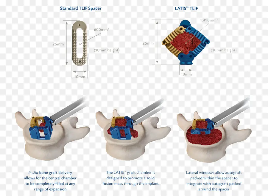 Implant Rachidien，Chirurgie PNG