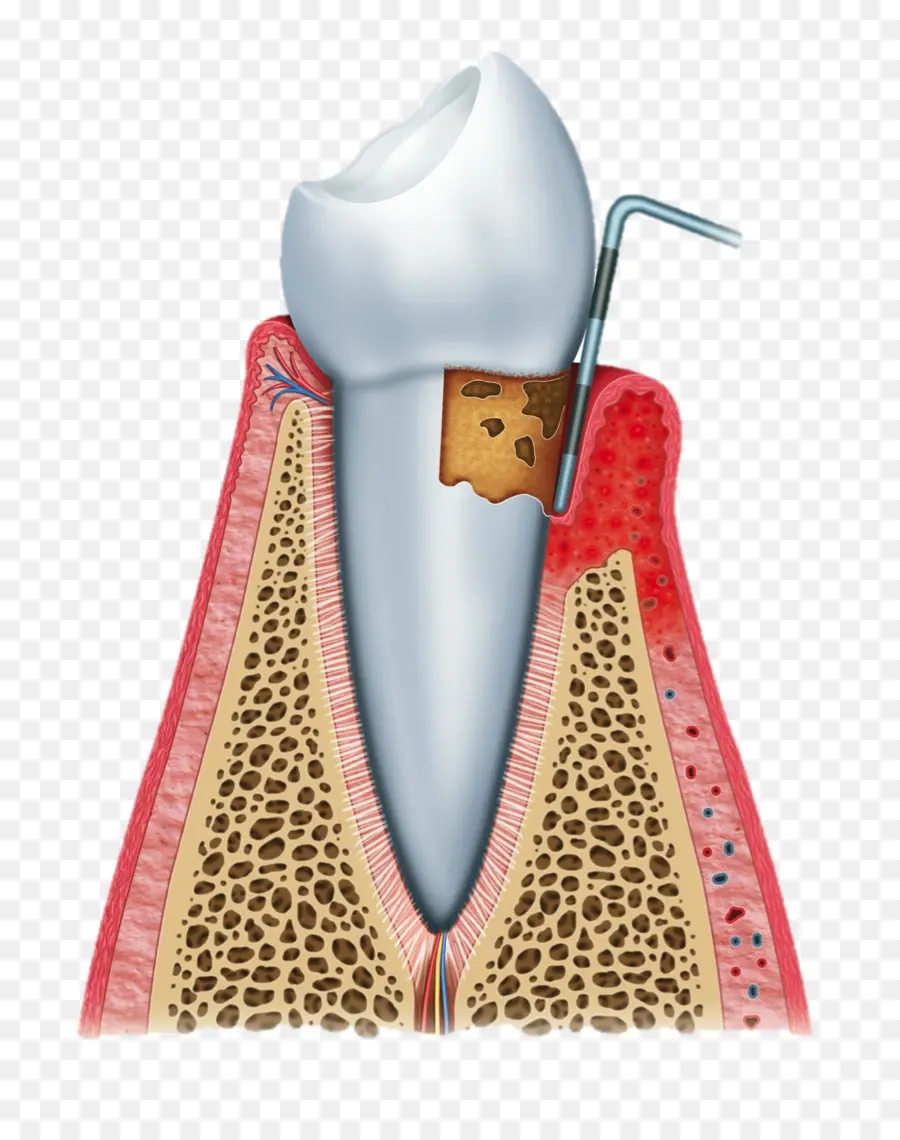 Dent Atteinte D'une Maladie Des Gencives，Dentaire PNG
