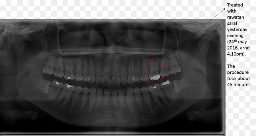 Dent De Sagesse，Les Maux De Dents PNG