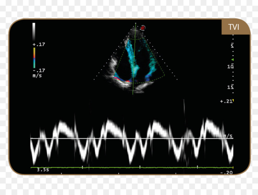 L échographie，L échocardiographie Doppler Tissulaire PNG