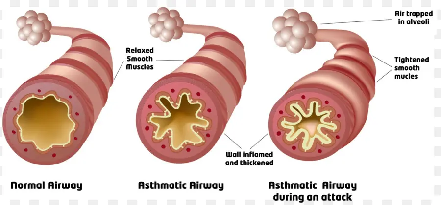 Voies Respiratoires Asthmatiques，Voies Aériennes PNG