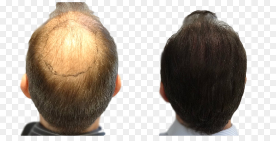 La Transplantation De Cheveux，L Extraction D Unités Folliculaires PNG