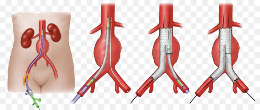 Anévrisme De L Aorte Abdominale，Endovasculaire De L Anévrisme De Réparation PNG