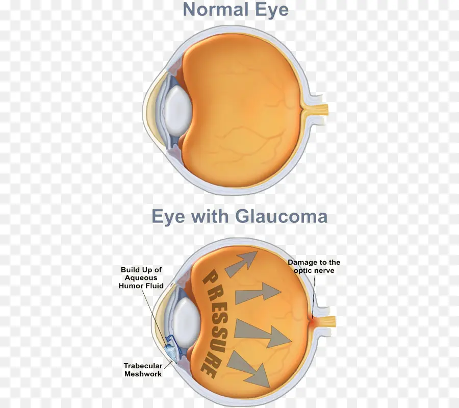 Comparaison Du Glaucome，œil PNG