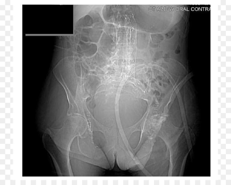 Anévrisme De L Aorte Abdominale，Endovasculaire De L Anévrisme De Réparation PNG