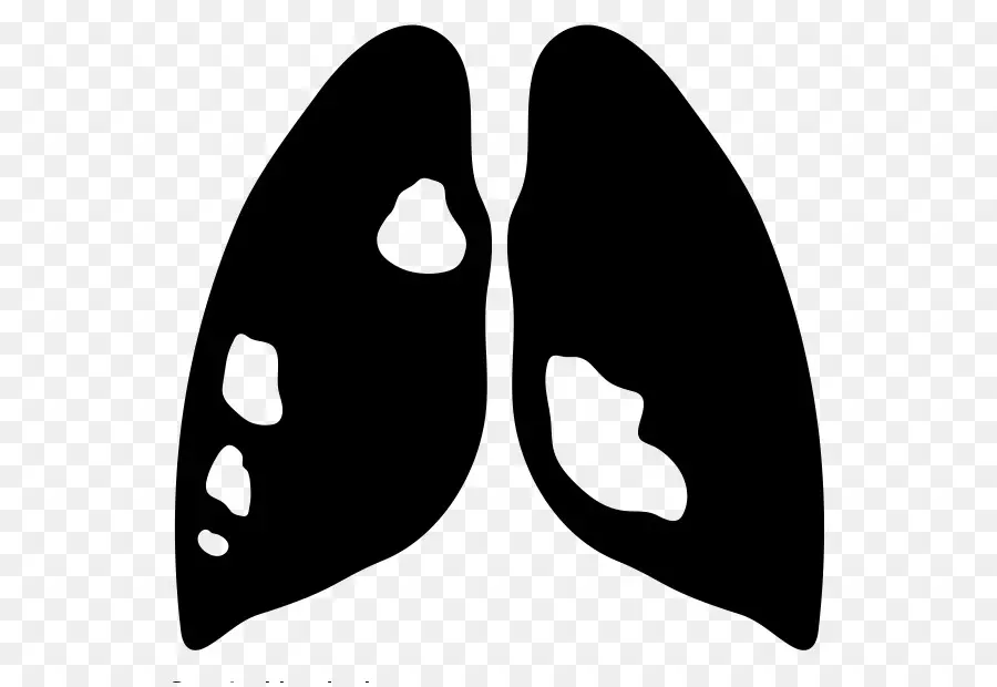 Poumon，Le Cancer PNG