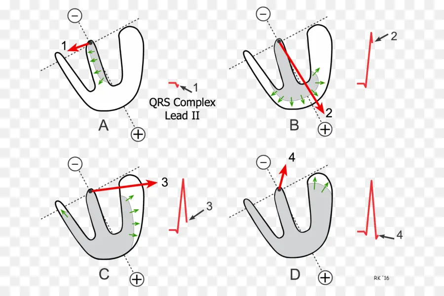 Complexe Qrs，Ecg PNG