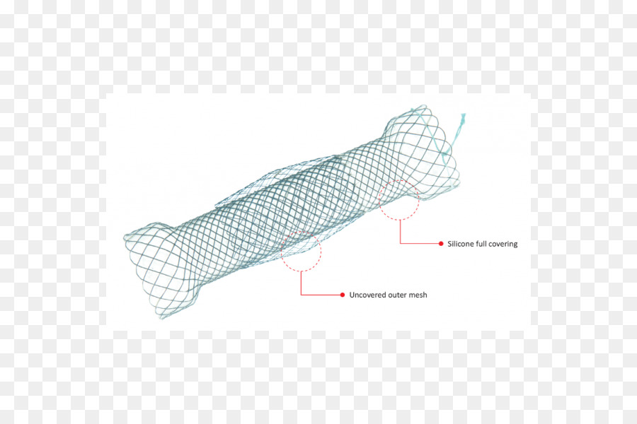 La Pose D Un Stent，Varices Oesophagiennes PNG