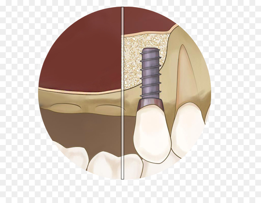 Implant Dentaire，Dent PNG