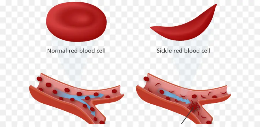 Globules Rouges，Drépanocytose PNG