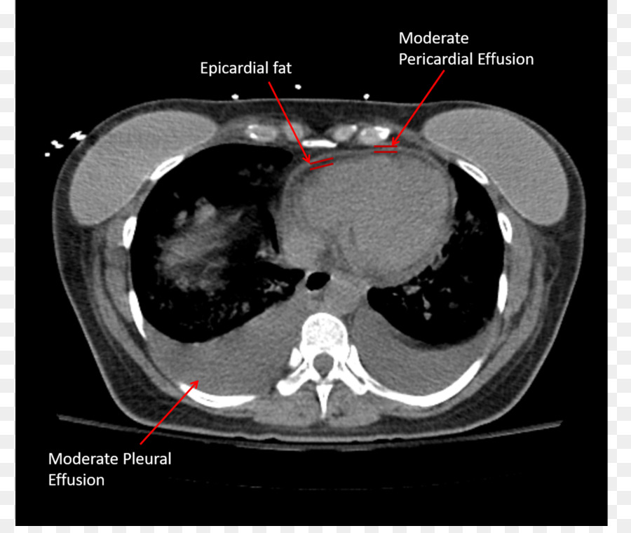 La Tomographie，Épanchement Péricardique PNG