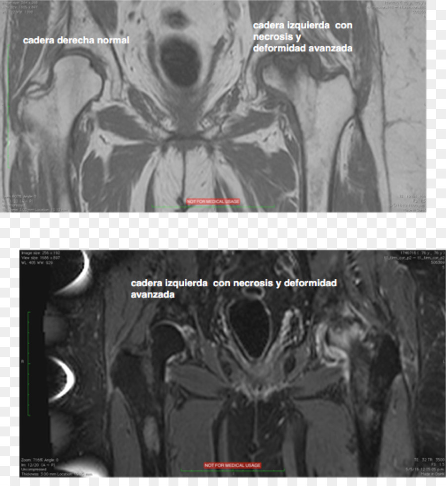 Infarctus Osseux，Tomodensitométrie PNG