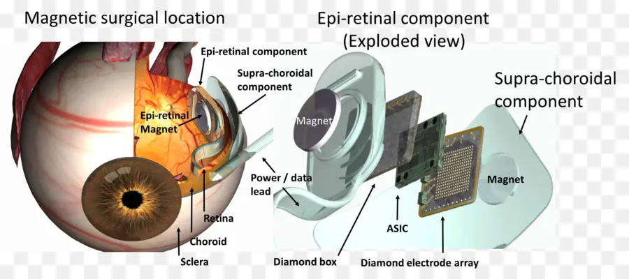 Implant Rétinien，œil PNG