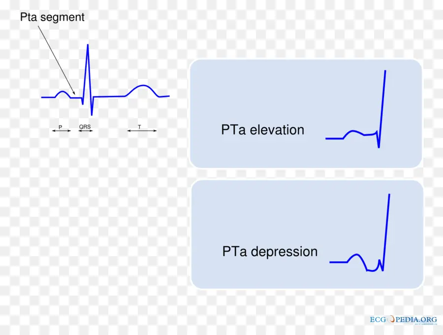 Graphique Ecg，Segment Pta PNG