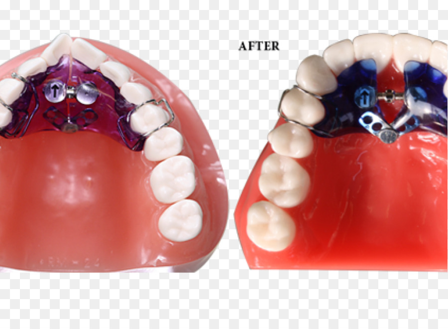 L Orthodontie，Appareil Ménager PNG