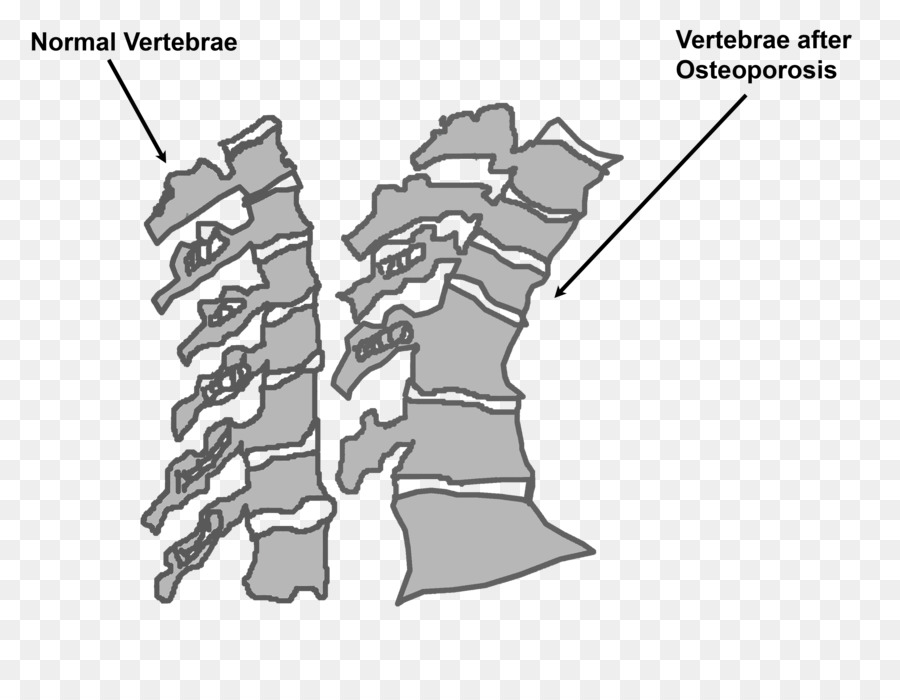 Ostéoporose，Colonne Vertébrale PNG