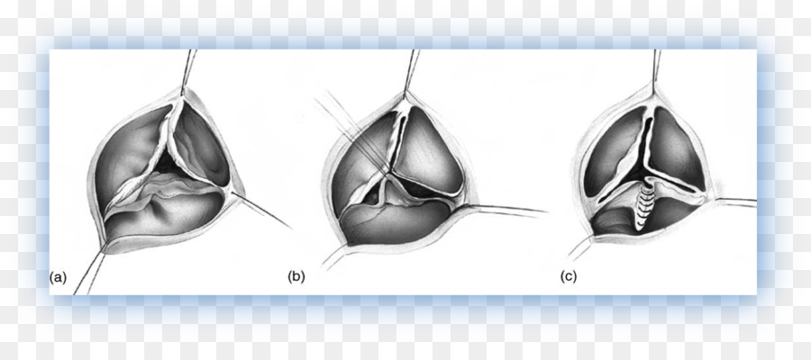 De La Valve Aortique，L Artère Coronaire Gauche PNG