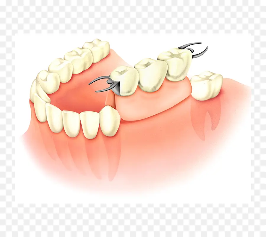 Dent，Les Prothèses Dentaires PNG