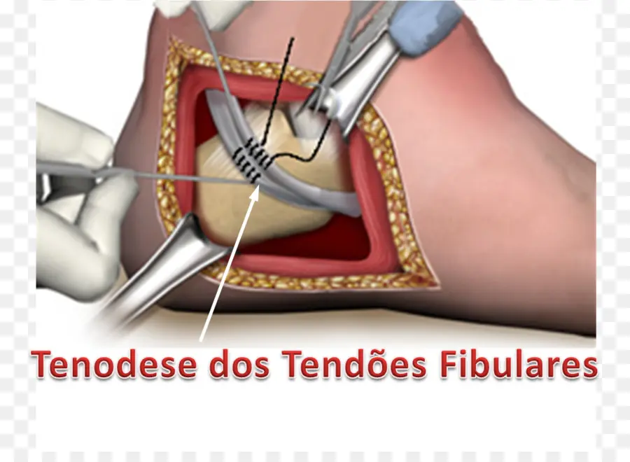 Chirurgie，Procédure PNG