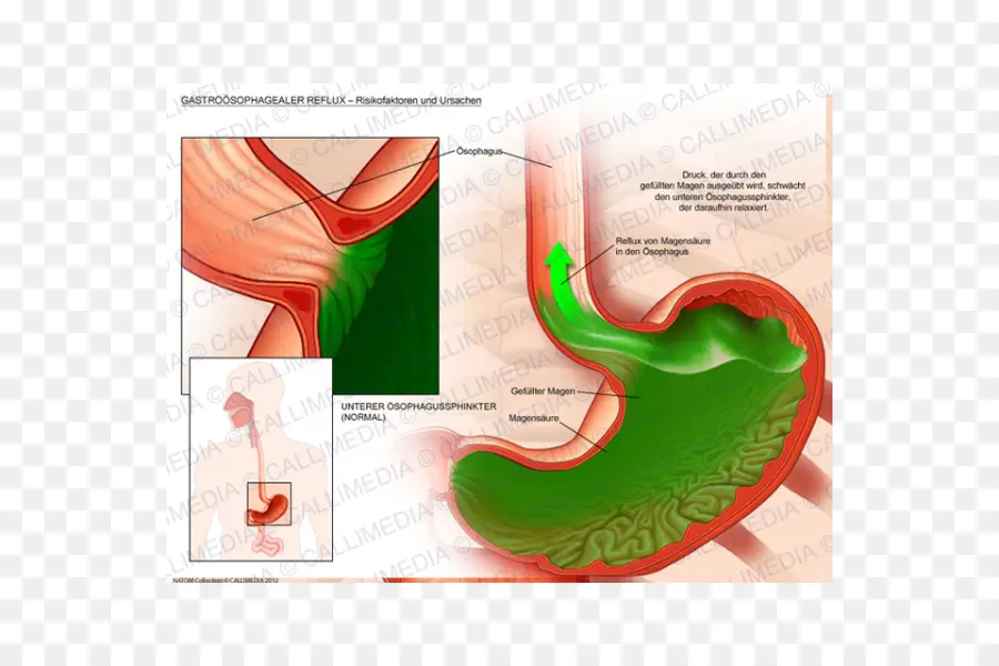 Estomac，Reflux PNG