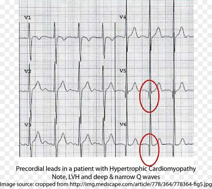 La Cardiomyopathie Hypertrophique，électrocardiographie PNG