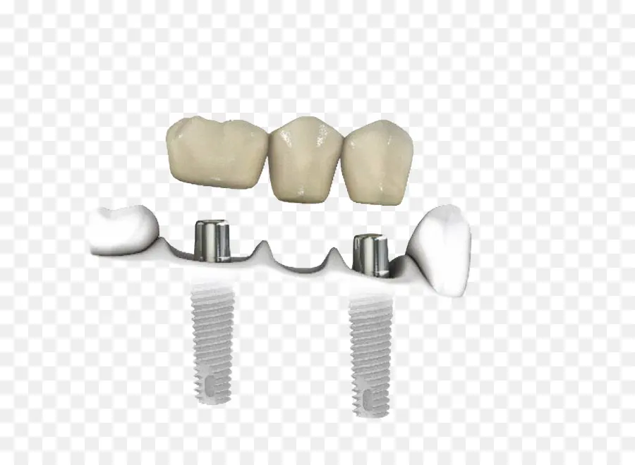 Implants Dentaires，Dents PNG