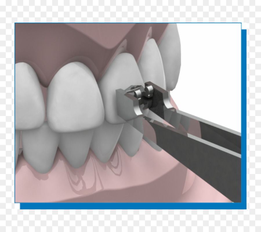 Les Croisillons Dentaires，L Orthodontie PNG