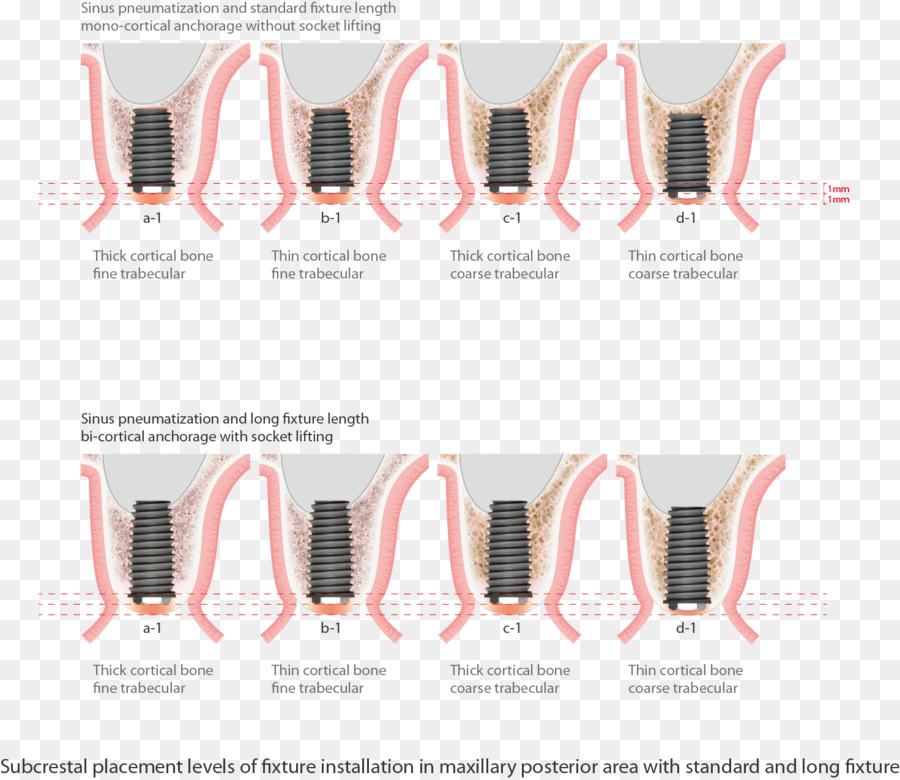 Implant Dentaire，Sinus Maxillaire PNG