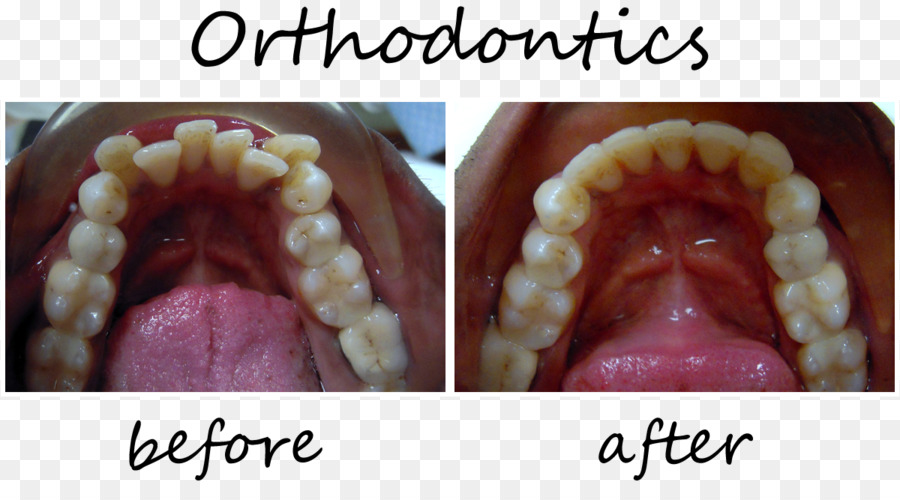 L Orthodontie，La Dentisterie PNG