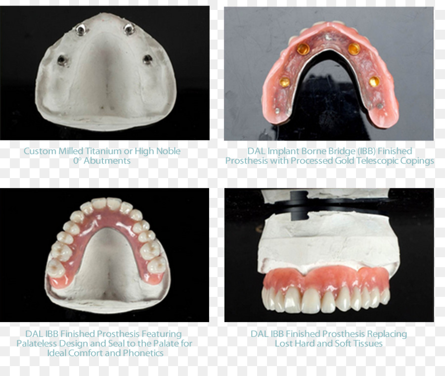 Prothèses Dentaires，Dentiers PNG