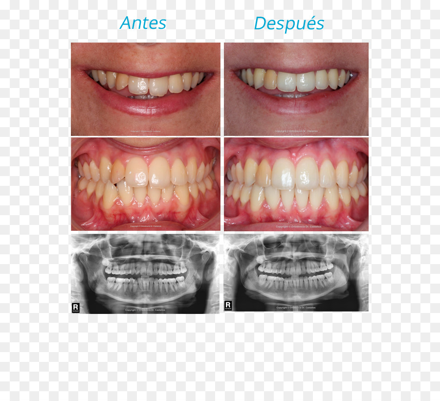 Dent，L Orthodontie PNG
