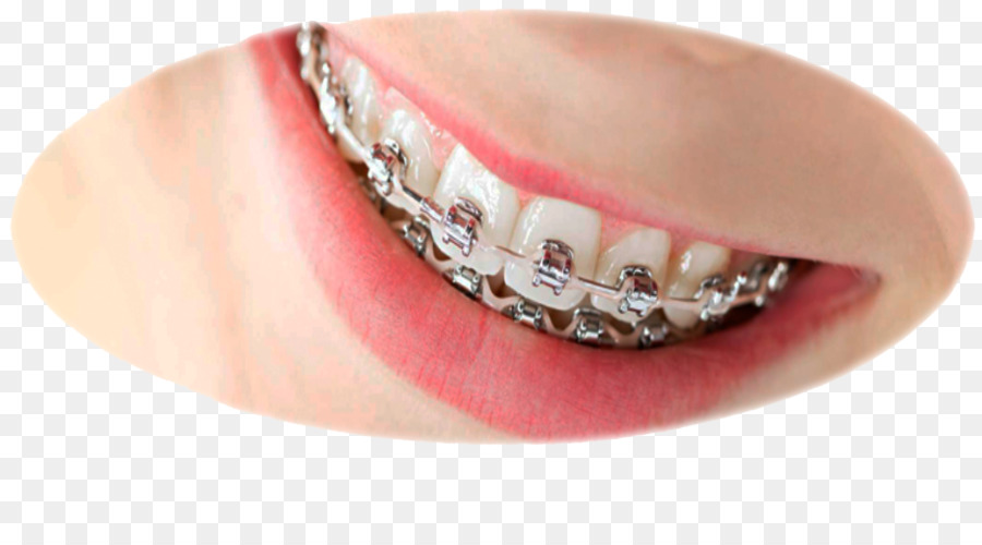 L Orthodontie，Les Croisillons Dentaires PNG