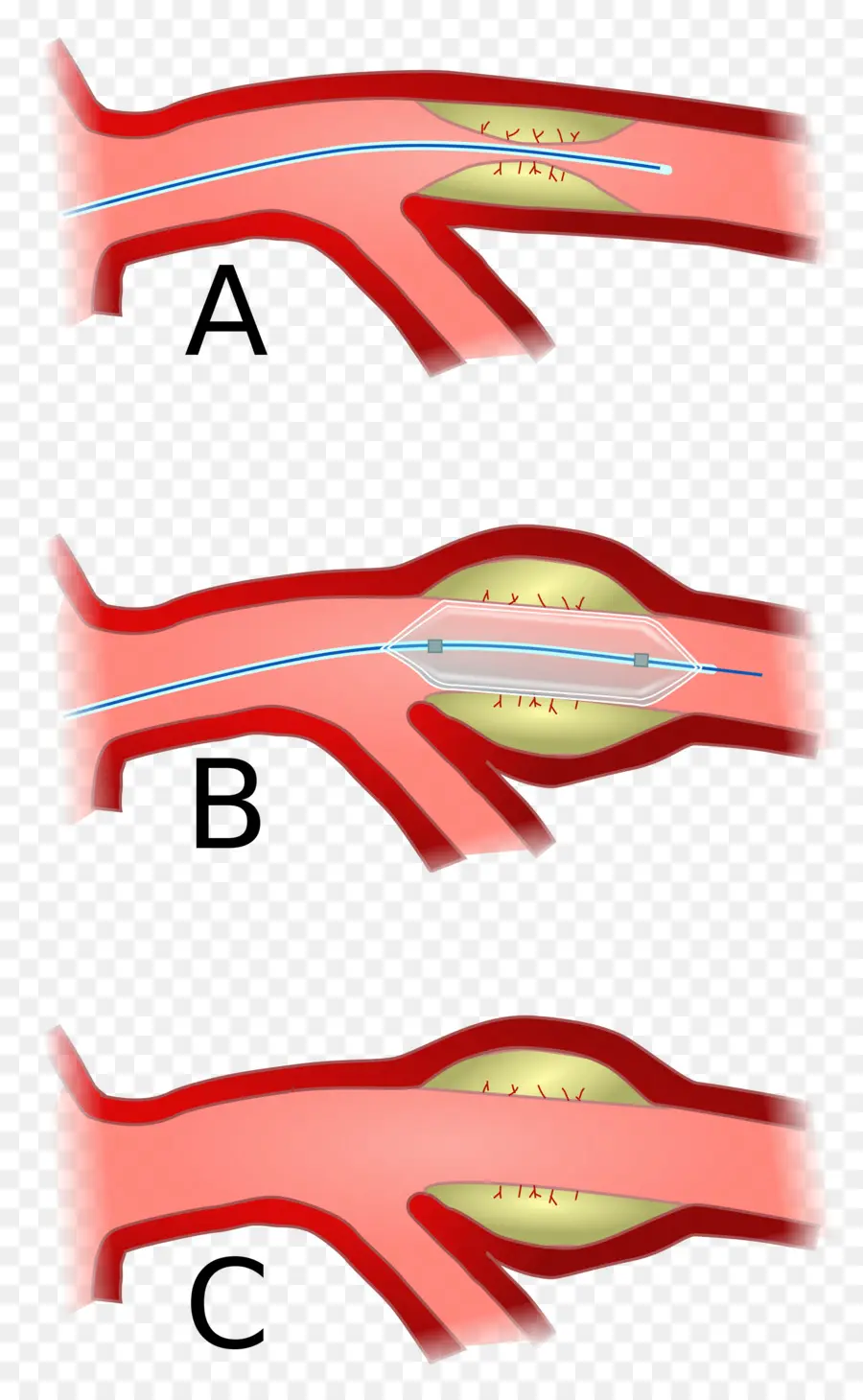 Angioplastie，Procédure PNG