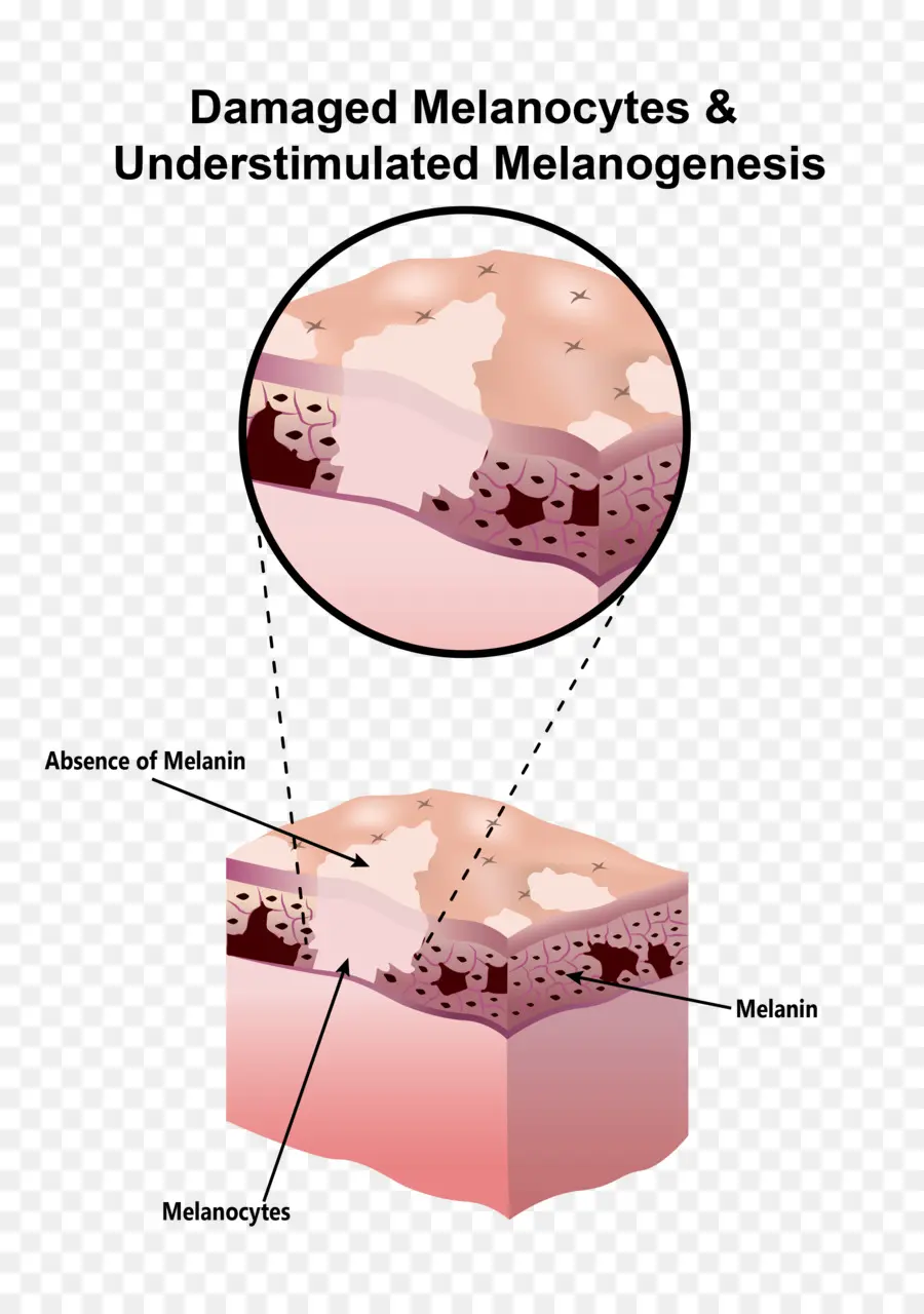 Mélanocytes Endommagés，Mélanine PNG