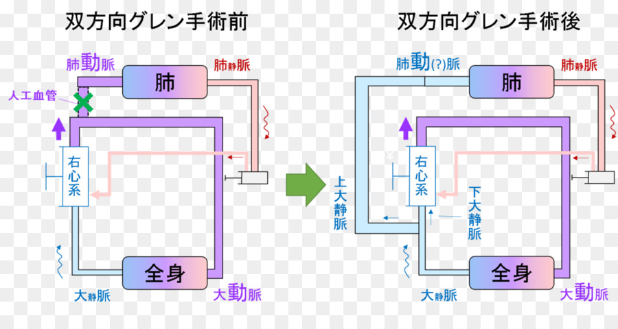 Fukuoka Municipal Des Enfants De L Hôpital，L Hypoplasie Du Cœur Gauche PNG